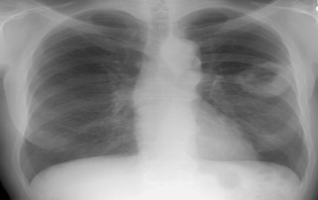 Рентген легочное кровотечение туберкулез. Какая бывает пневмония у взрослых название. Рентгенологическая картина фурункула. Подозрение на зон. Подозрение на зон.